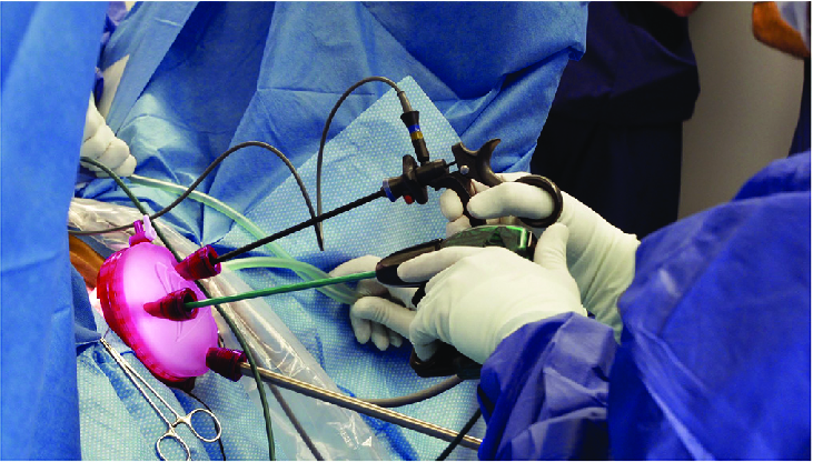 Laparoskopi: Minimal İnvaziv Cerrahi ile Hızlı ve Konforlu İyileşme